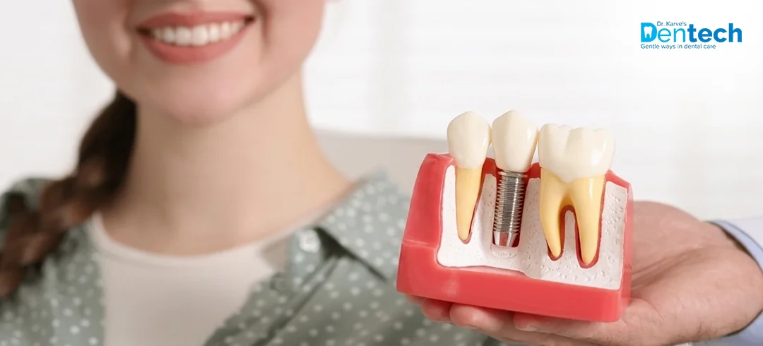 Dental Implants in Thane at Dr. Karve's Dentech